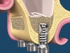 Bone Grafting for Implants