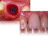 Dental Implants to Replace Teeth