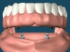 Dental Implants for Dentures