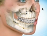 Jaw Surgery for Better Bite & Smile