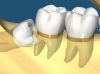 Wisdom Teeth Removal