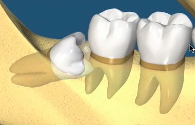 'No Swelling' 3rd Molar Removal