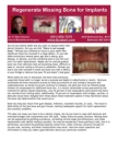 Bone Grafting for Implants