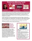 Dental Implants
