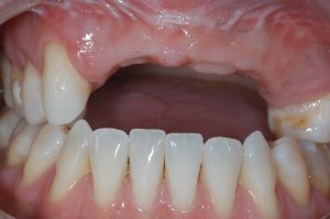 Loss of bone after trauma