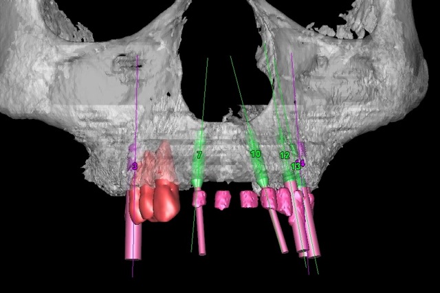 CT Scan Guided Implants