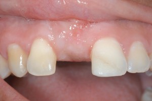 front missing tooth Front missing tooth