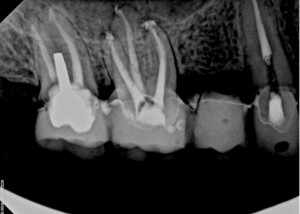 Photo Poll: Bridge or Dental Implant