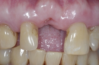 Bone graft to extraction site