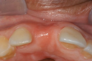 Missing incisor with thin bone