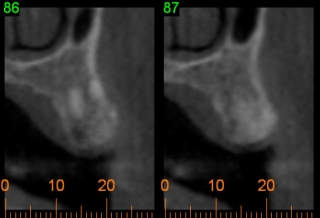 CT scan images for dental implants