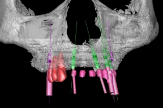 3-dimensional model for dental implant plan