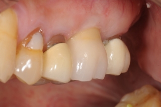 Implant crown- Dr. Kazemi oral surgeon