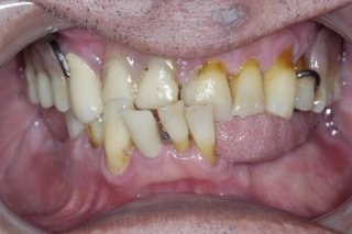 gum disease and tooth decay with extraction and immediate implants