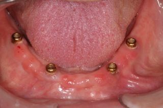 Four immediate dental implants