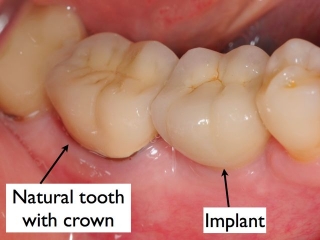 Final crown on dental implant- Dr. Kazemi