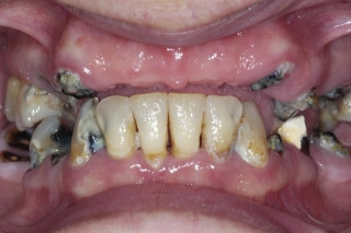 extraction of decayed teeth