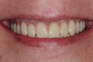 Cosmetic results with a new smile