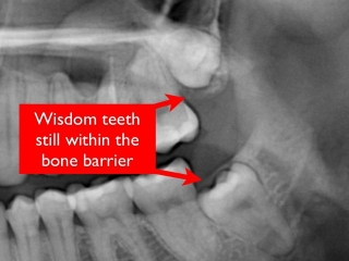 Impacted wisdom teeth- Dr. Kazemi