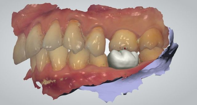 Intraoral dental scan with digital waxup