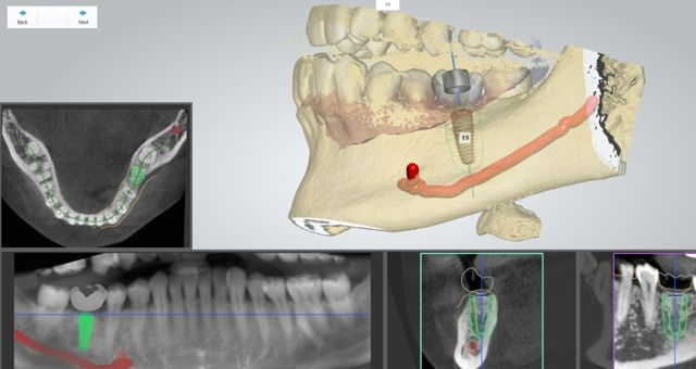 computer assisted dental implant planning