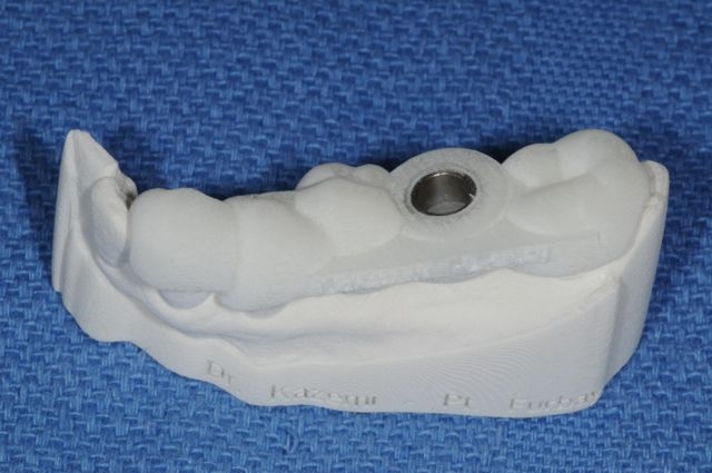 CAD /CAM surgical guide for dental implants