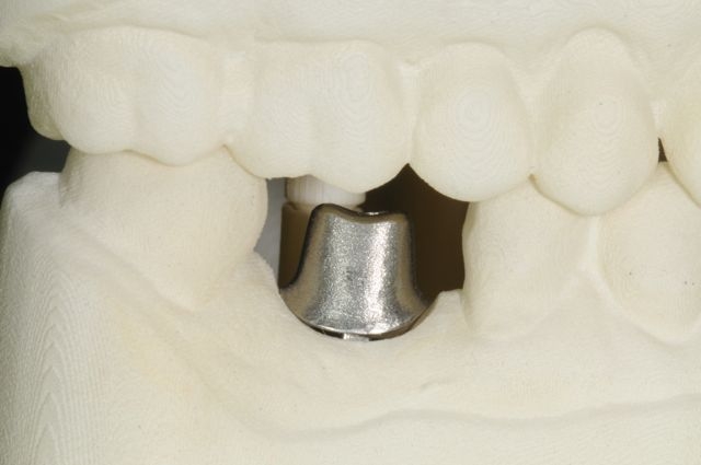 CAD :CAM implant custom abutment