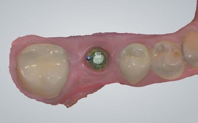 Intra-oral digital scan of implant soft tissue