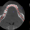 AR- CBCT crestal bone loss