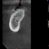 AR- CBCT after bone grafting