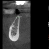 AR- CBCT thin bone 2