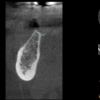 AR- CBCT thin bone