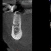 AR- CBCT after bone grafting