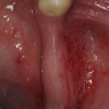 Loss of bone due to missing teeth- insufficient for implant placement