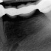 Failing dental bridge