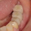 AR- final dental implant crowns clinical 2