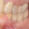 AR- final crowns clinical 3
