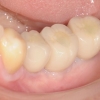 AR- final implant supported crowns clinical