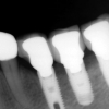 AR- final implants xray