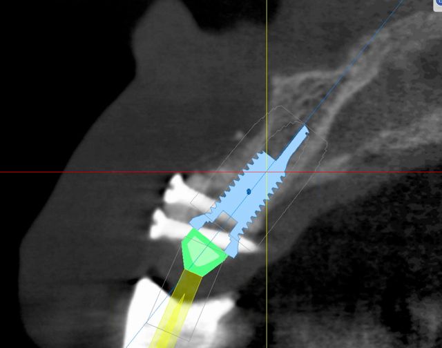bone-graft-and-implant-simulation
