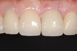 final-incisor-crown