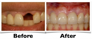 implant-before-and-after-2