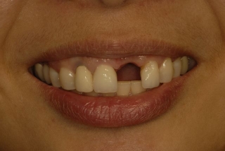 missing-tooth-9
