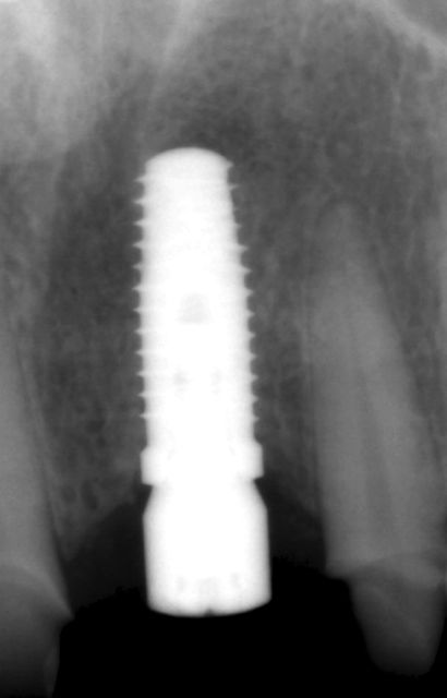 dental-implant-9