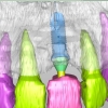 cbct-3-d-implant-work-up