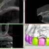 cbct-work-up-for-implant