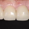 final-incisor-crown