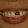 missing-tooth-9