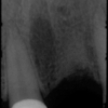 missing-tooth-xray