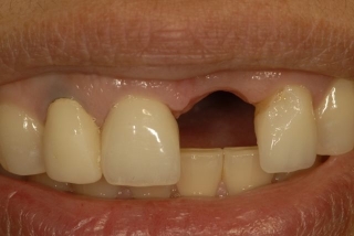 Missing mixillary incisor